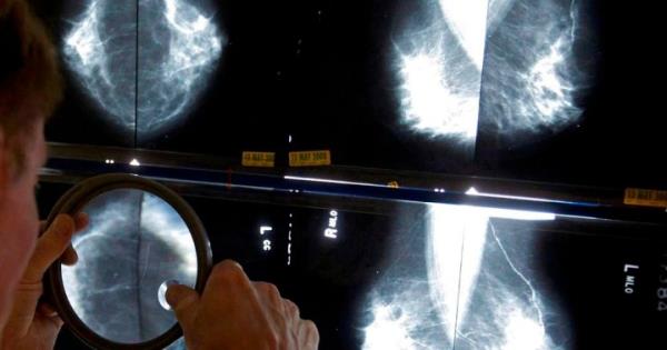 纽芬兰卫生局正在审查大约3000张乳房x光片，以寻找可能的问题